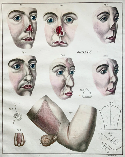 1827 Fred. Frick Imperial Folio Masterpiece Anatomical Book Illustration Rhinoplasty Plastic Surgery - 50.5cm Medicine