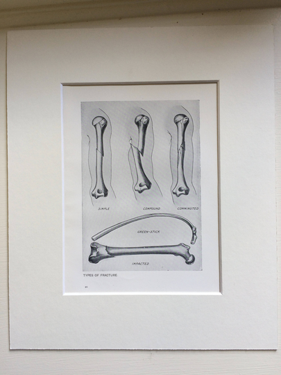 1920S Original Antique Matted Anatomical Print - Types Of Fracture | Simple, Compound, Comminuted, Green Stick, Impacted Anatomy Medicine