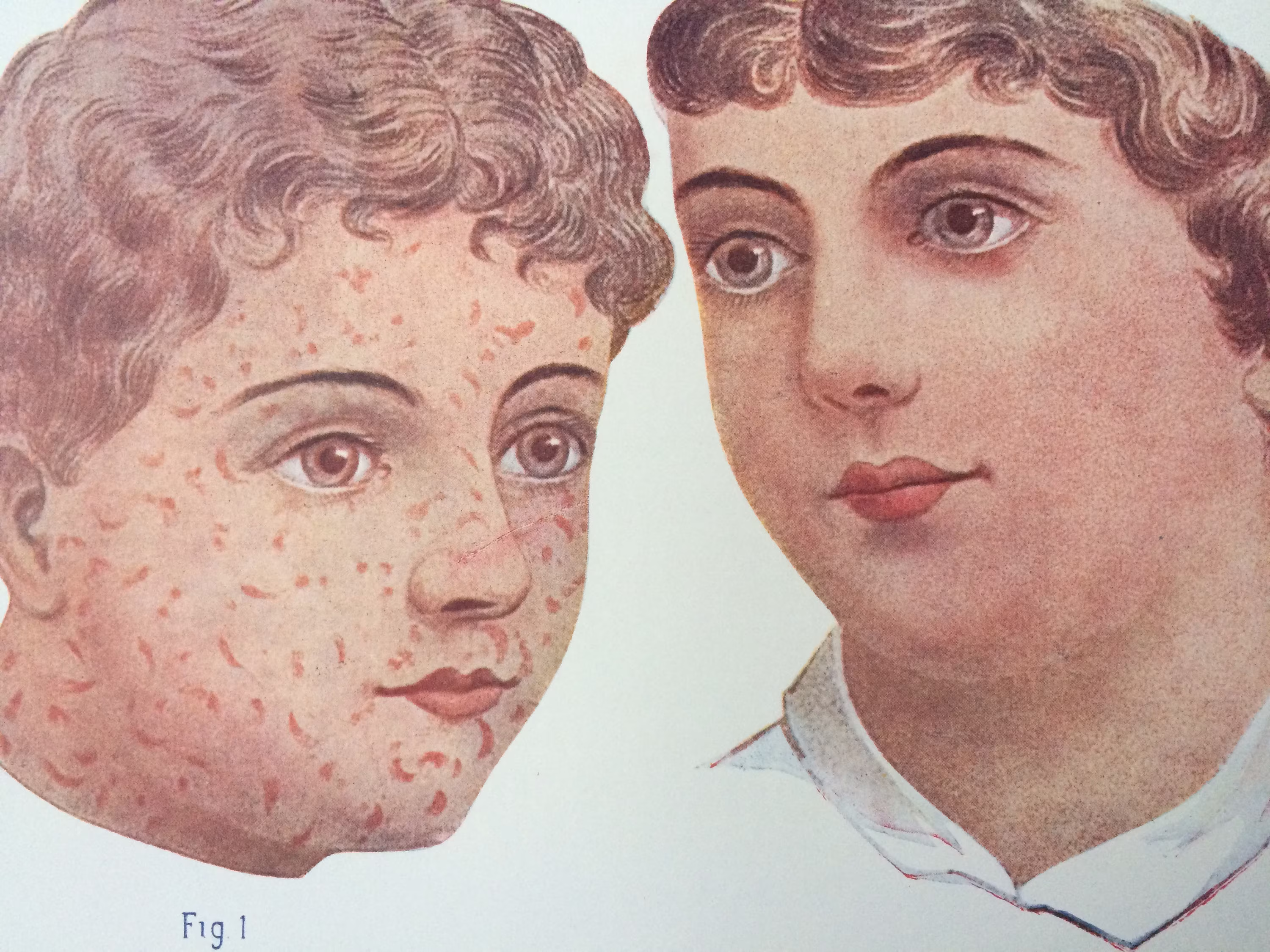 1925 Original Antique Matted Anatomical Print - Measles & Scarlet Fever Medical Decor Medicine Anatomy Diseases