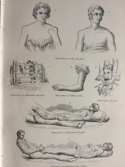 1891 Dislocations Original Antique Engraving - Encyclopaedia Illustration Wall Decor Home Medical Anatomy