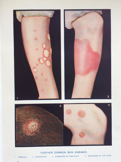 1920S Original Antique Matted Anatomical Print - Further Common Skin Diseases Anatomy Medicine Psoriasis, Erysipelas, Ringworm