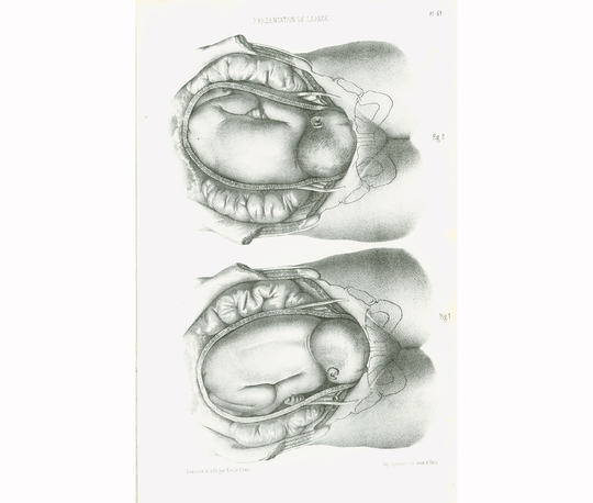 1865 Human Fetus, Antique Obstetrics Print Xl, Anatomy Embryology Gynecology Bourgery Victorian Wall Art 163 Years Old, Medical Chart